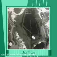 تومور پارافارنکس