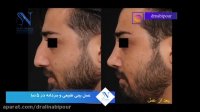 فیلم عمل بینی مردانه