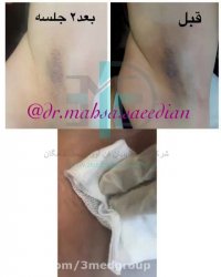 درمان تیرگی زیر بغل  (2جلسه کربوکسی تراپی )