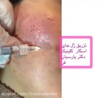 درمان اسکار اتروفیک ناشی از جوش