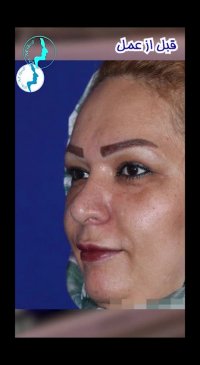 جراحی زیبایی بینی دو خواهر توسط دکتر گلی جراح بینی تهران
