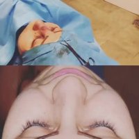 انتهای عمل بینی | دکتر گلی