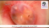 فیلم عفونت گوش