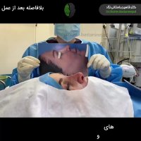 جراحی ترمیمی بینی برای بار چهارم توسط دکتر باستانی نژاد | جراح بینی تهران