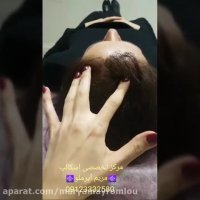 انجام میکرواسکالپ برای خانمهایی که موهای کم پشت دارند