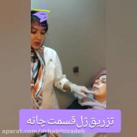 تزریق ژل قسمت چانه