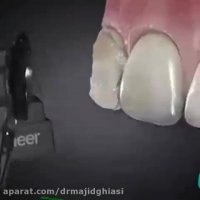 ونیر دندانی-دکترمجیدقیاسی دندانپزشک زیبایی مشهد