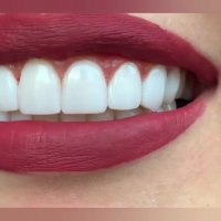 انجام 8 واحد لمینیت سرامیکی