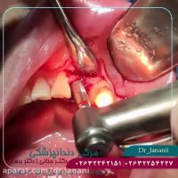 جراحی ایمپلنت