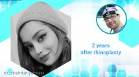 دو سال بعد از جراحی بینی | بهترین جراح بینی تهران