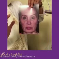 جراحی بینی ثانویه