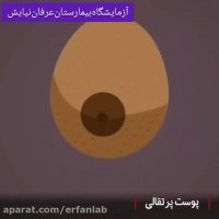 نشانه‌های اولیه سرطان سینه