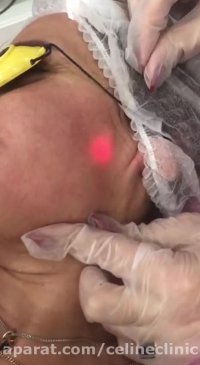 لیزر اندولیفت