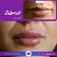 تزریق ژل لب در کلینیک ارکیده