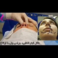 فیلم عمل جراحی بینی قوزدار