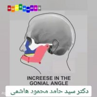 از دست دادن دندان و تحلیل فک