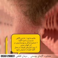 چرا بعضی از افراد درگیر بیماری اگزما پوستی میشن؟