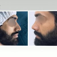 نمونه کارهای عمل بینی توسط دکتر مسعود انظاری