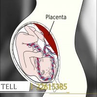 زایمان سزارین