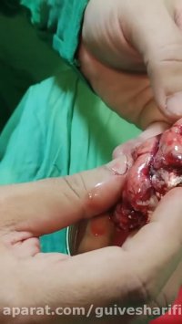 215. تشنج در دختر ۱۳ ساله باعث تشخیص تومور عمقی در داخل لب تمپورال شد