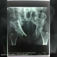 ۳ ماه بعد شکستگی لگن