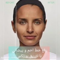 برطرف نمودن خط پیشانی و اخم با تزریق بوتاکس