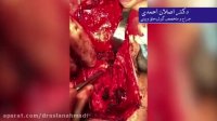 سرطان پاپیلری وسیع عود کرده با تهاجم به حنجره