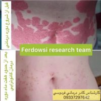 پیسی ویتلیگو درمان شد