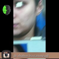 جراحی بینی استخوانی قوزدار | دکتر باستانی نژاد جراح بینی تهران