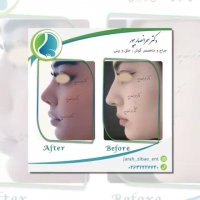 فیلم نمونه جراحی بینی دکتر انصاریپور