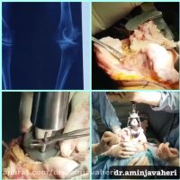 تعویض مفصل زانو توسط دکتر سید علیرضا امین جواهری