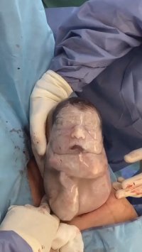 عمل سزارین دوقلو