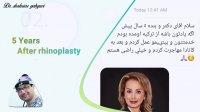 پنج سال بعد از جراحی بینی