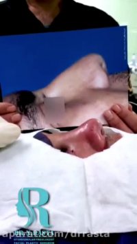 نمونه کار جراحی بینی در مردان