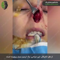 فیلم جراحی بینی ترمیمی بسیار مشکل | دکتر باستانی نژاد جراح بینی