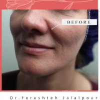 فیلم لیفت صورت با نخ سلوهت