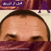 فیلم تزریق بوتاکس به پیشانی