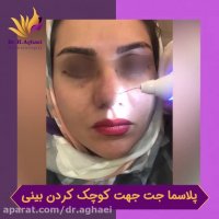 فیلم جالب از کوچک کردن بینی بدون جراحی