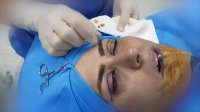 جراحی پلک بالا توسط دکتر شهریار یحیوی