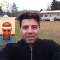 کاشت مو کلینیک رنسانس