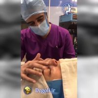 عمل زیبایی بینی گوشتی