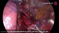 جراحی لاپاراسکوپی آشالازی - دکتر داود نریمان زاده