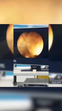 فیلم عمل جراحی سنگ کلیه با آندوسکوپی