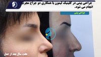 نتیجه جراحی زیبایی بینی توسط کلینیک لیمون