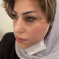 نظر مراجعین کاشت ابرو