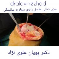 نمای داخلی مفصل زانوی ساییده شده