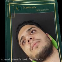 فیلم نمونه کار جراحی بینی بعد از یک ماه - جراحی بینی در لرستان