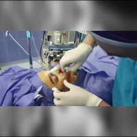 تزریق فیلر به گونه همزمان با جراحی بینی | دکتر شهریار یحیوی