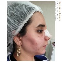 زاویه سازی صورت با تزریق چربی به روش نانوفت