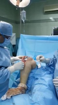 تعویض مفصل زانو دکتر حبیب رشادی
